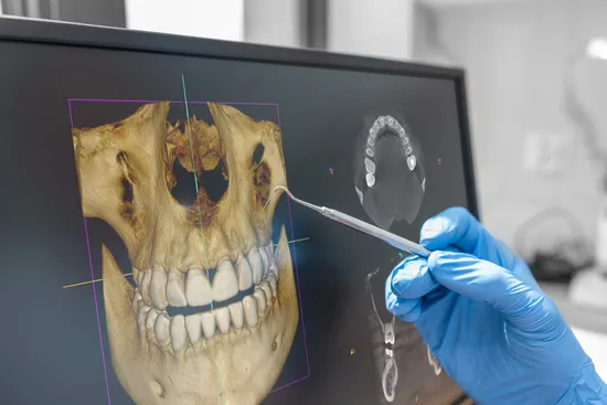 CBCT