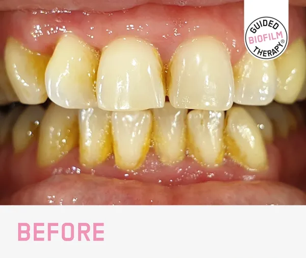 GBT guided biofilm therapy