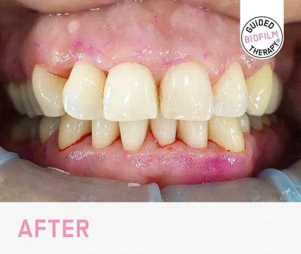 GBT guided biofilm therapy